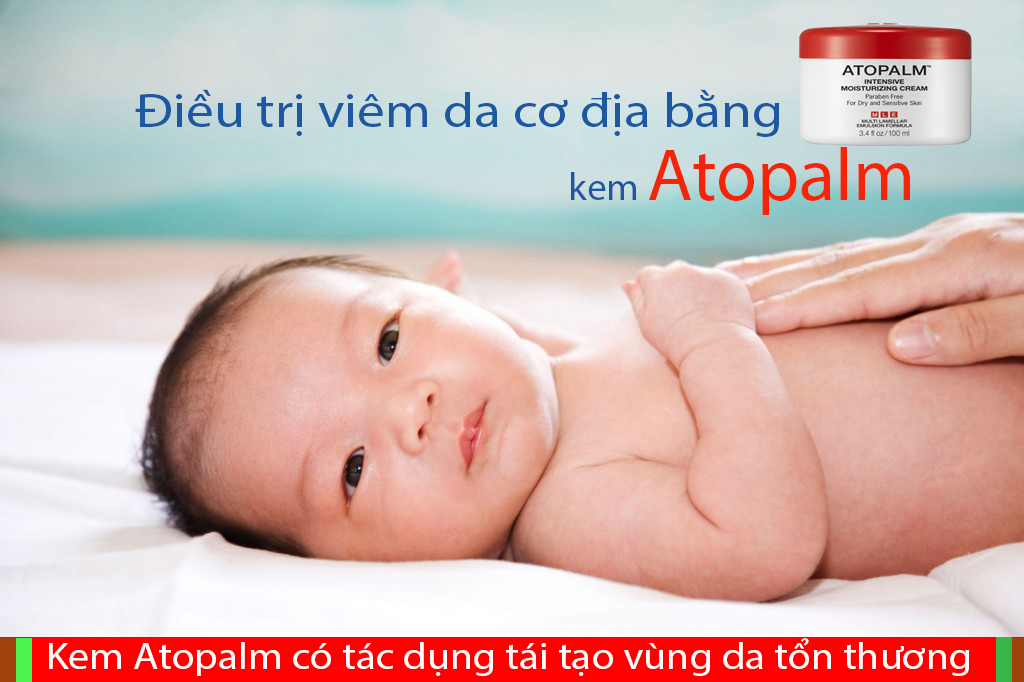 Điều trị viêm da cơ địa bằng Atopalm