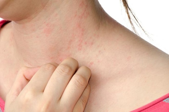 Viêm da cơ địa ở người lớn - DP Tâm Đan